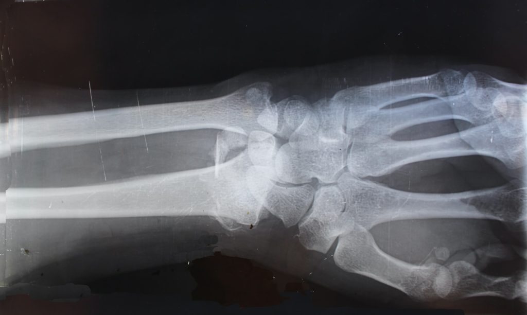 X-ray of a wrist. Photo by Cara Shelton on Unsplash