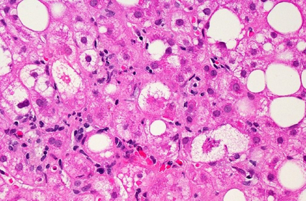 A microscopic image of liver tissue affected by non-alcoholic fatty liver disease (NAFLD). The large and small white spots are excess fat droplets filling liver cells (hepatocytes). Credit: Dr. David Kleiner, National Cancer Institute/NIH