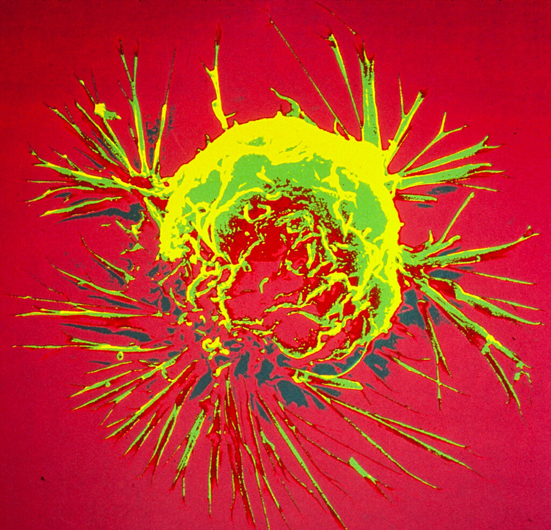 A breast cancer cell