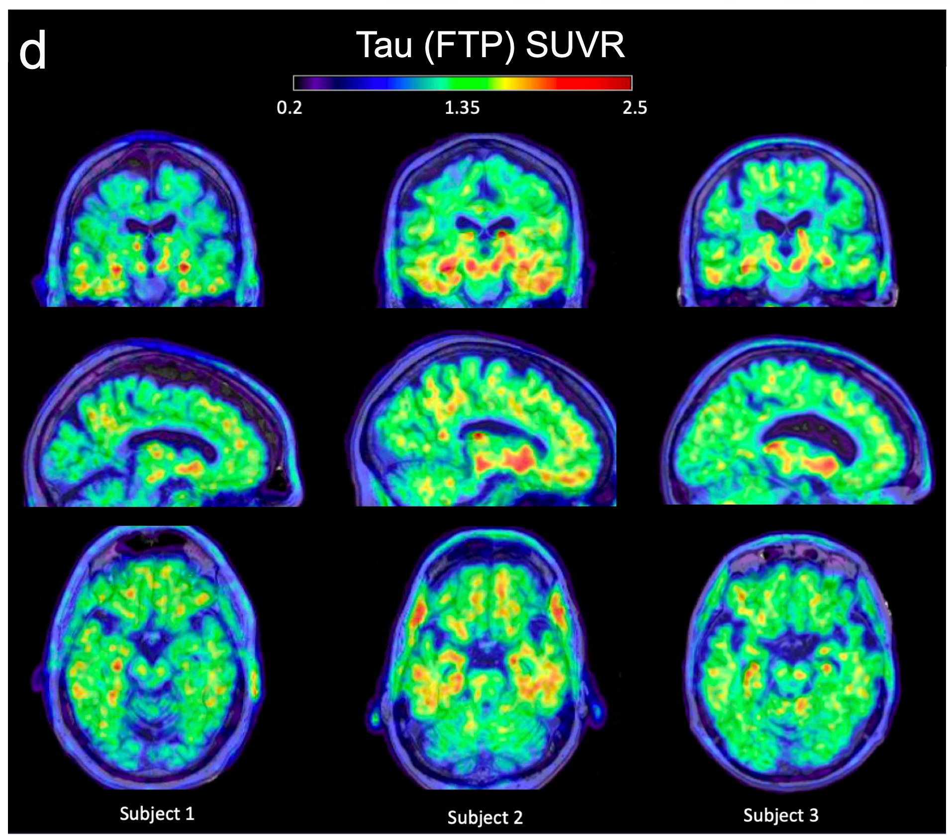 Three columns of three images each that are PET scans of brains. Each column contains